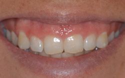 Before Crown Lengthening by Periodontist Dr. Kissel