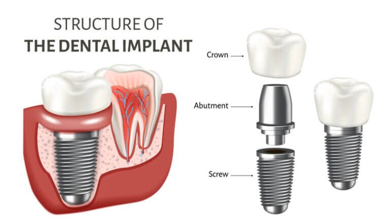 structure of dental implant